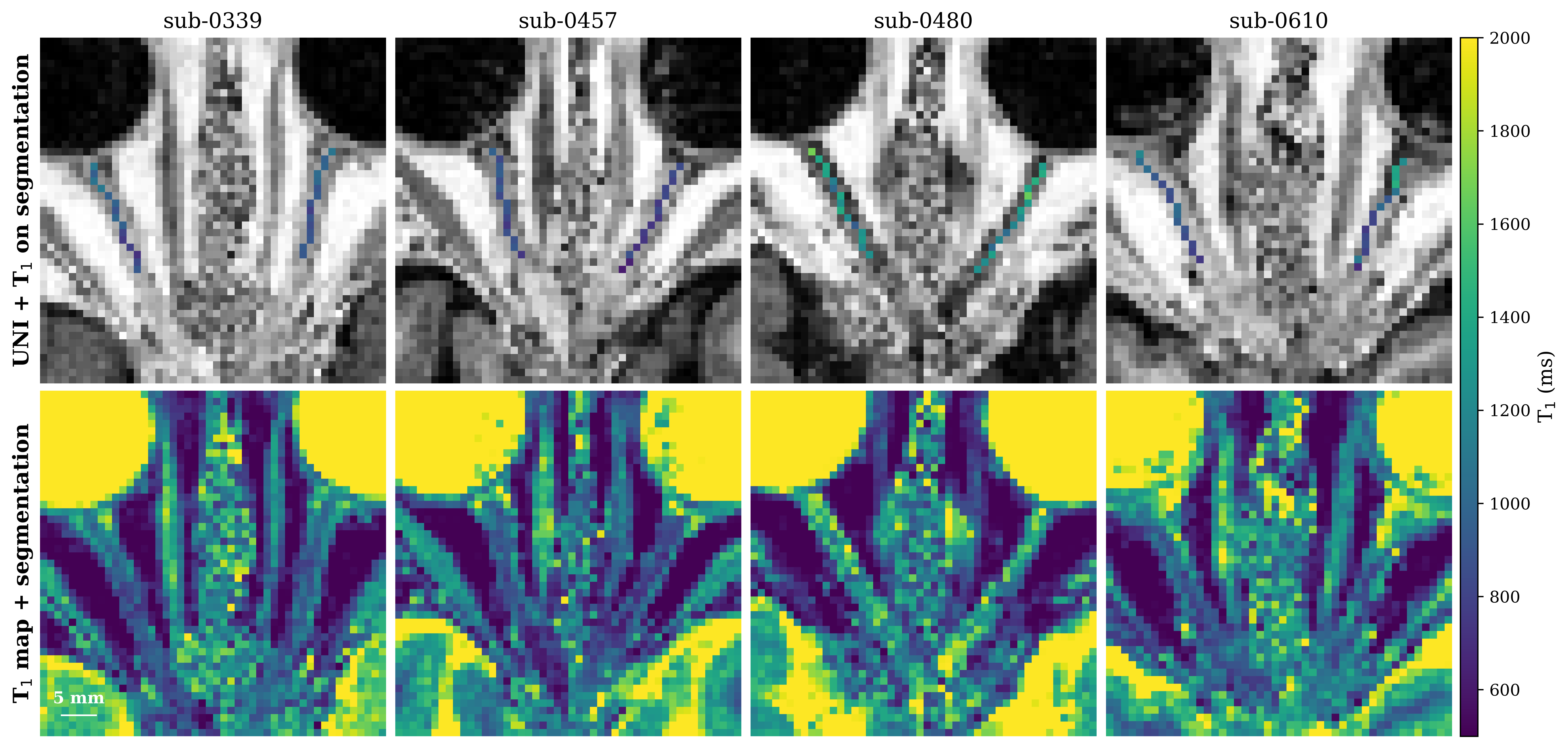 Unfolded views of the intraorbital optic nerve for four participants (sub-0339, sub-0457, sub-0480, sub-0610). Top row: UNI images + T_1 optic nerve segmentations illustrating skeleton-based voxel extraction. Bottom row: corresponding T_1 maps.